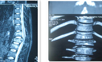 頸、胸、腰椎手術(shù)治療